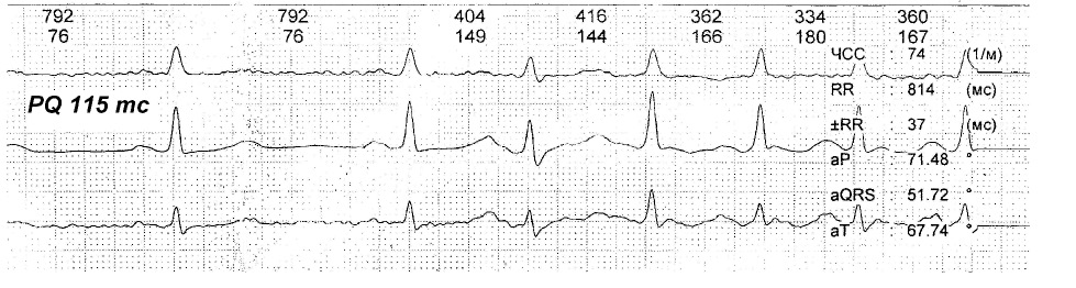 Феномен укороченного pq. CLC синдром ЭКГ. Феномен укороченного PQ на ЭКГ. Синдром укороченного интервала PQ. CLC синдром ЭКГ признаки.
